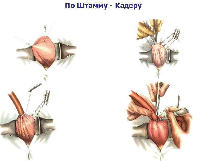 По Штамму - Кадеру 