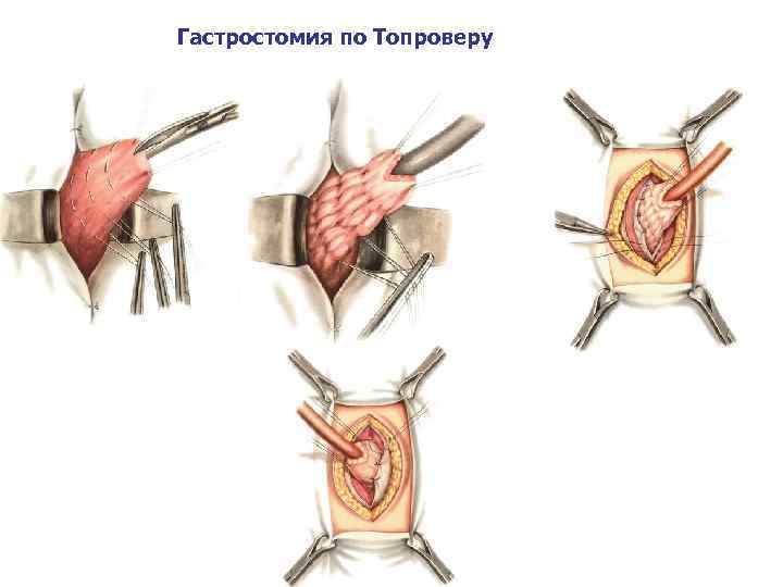 Гастростомия по Топроверу 