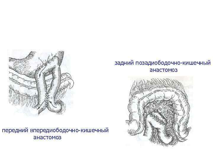 Кишечные анастомозы