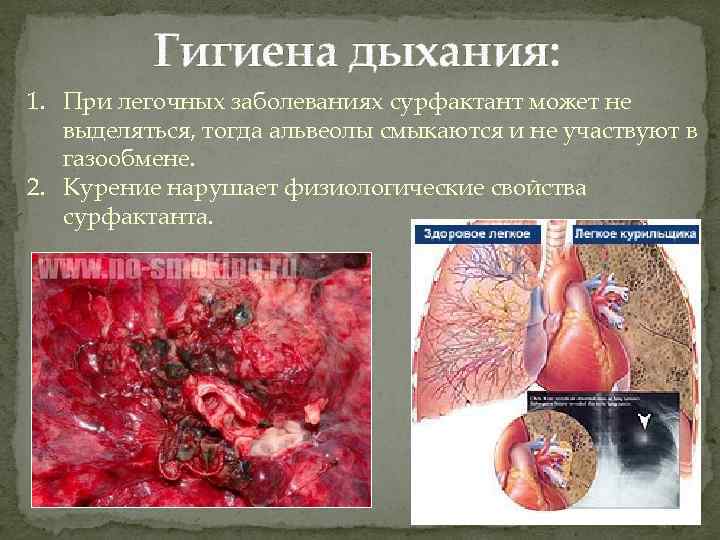 Гигиена дыхания: 1. При легочных заболеваниях сурфактант может не выделяться, тогда альвеолы смыкаются и