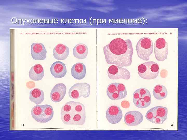 Опухолевые клетки (при миеломе): 