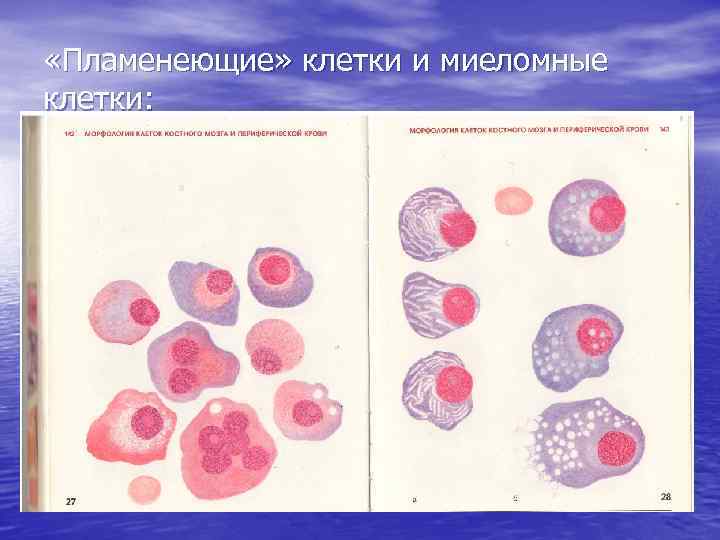  «Пламенеющие» клетки и миеломные клетки: 