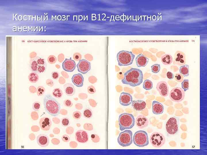 Анализы при в12 дефицитной анемии