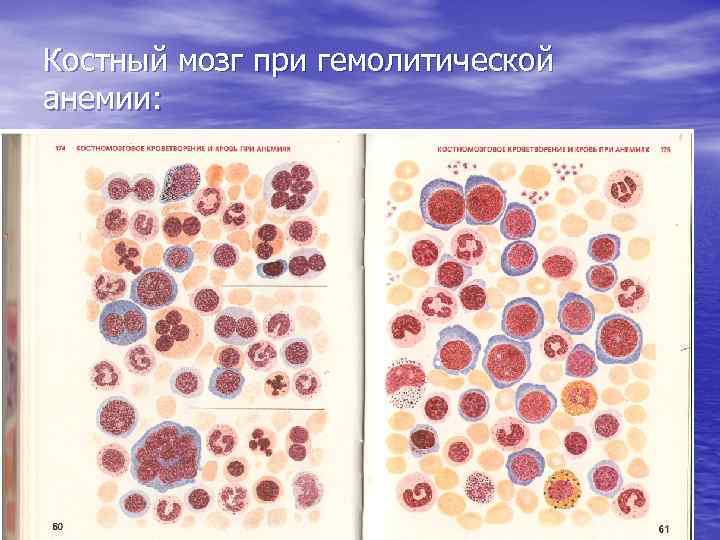 Картина крови при мегалобластной анемии