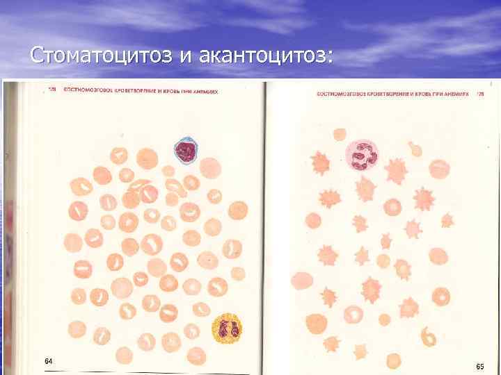 Стоматоцитоз и акантоцитоз: 