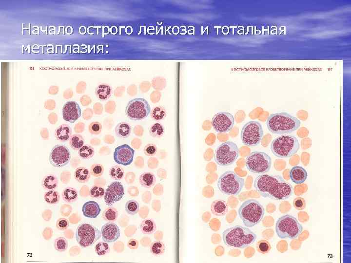 Начало острого лейкоза и тотальная метаплазия: 