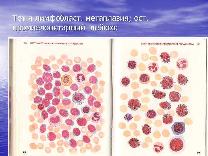 Тот-я лимфобласт. метаплазия; ост. промиелоцитарный лейкоз: 