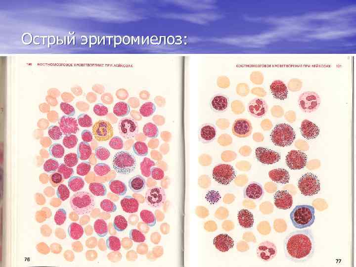 Острый эритромиелоз: 