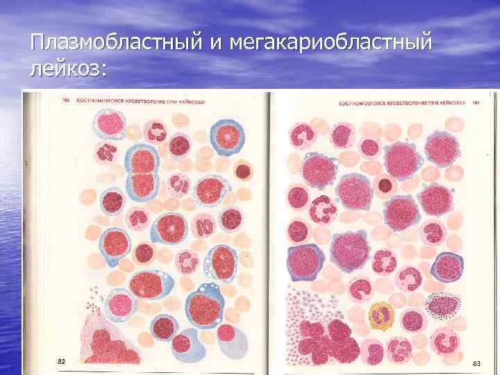 Плазмобластный и мегакариобластный лейкоз: 