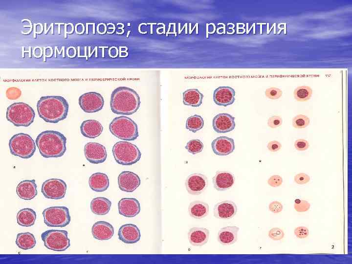 Нормоцит это. Полихроматофильный нормоцит. Оксифильный нормоцит в крови. Нормоциты в мазке крови. Оксифильные нормоциты в мазке крови.