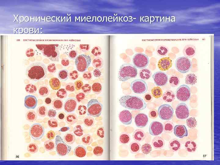 Хронический миелолейкоз- картина крови: 