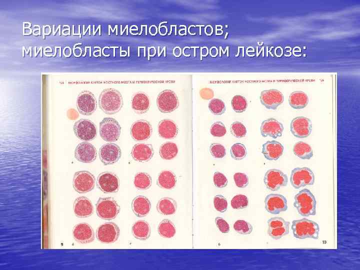 Вариации миелобластов; миелобласты при остром лейкозе: 