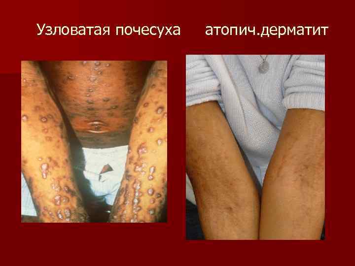 Узловатая почесуха атопич. дерматит 
