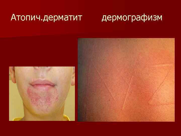 Атопич. дерматит дермографизм 