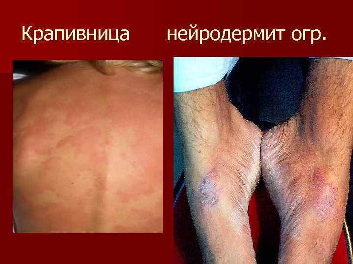 Крапивница нейродермит огр. 