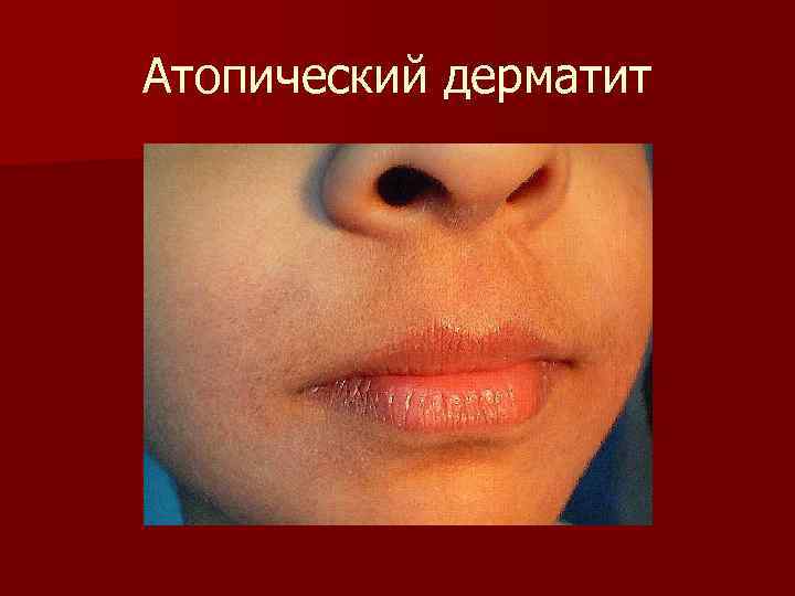Атопический дерматит 