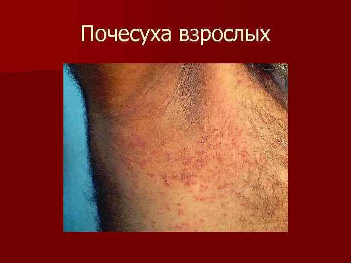 Почесуха взрослых 