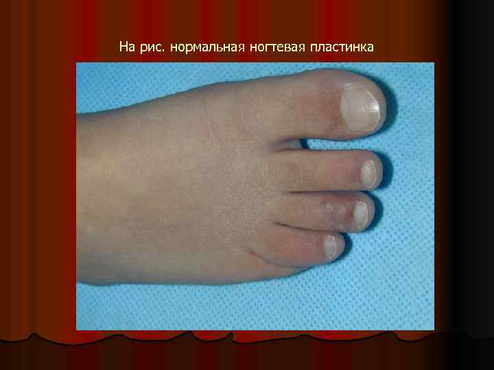 На рис. нормальная ногтевая пластинка 