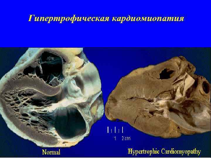 Гипертрофическая кардиомиопатия 