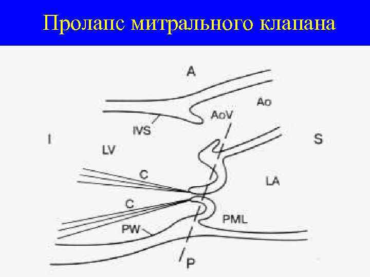 Пролапс митрального клапана 