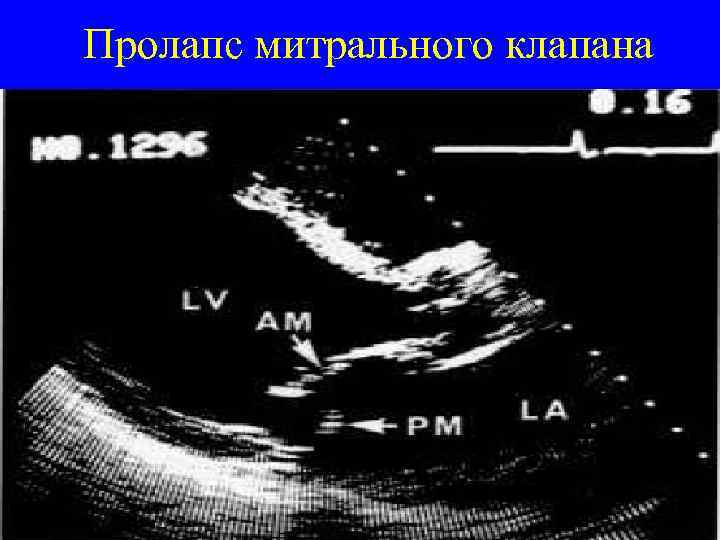 Пролапс митрального клапана 