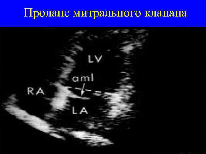 Пролапс митрального клапана 