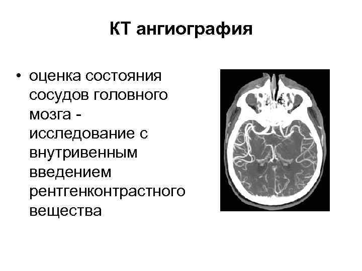 КТ ангиография • оценка состояния сосудов головного мозга - исследование с внутривенным введением рентгенконтрастного