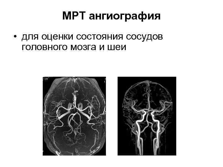 МРТ ангиография • для оценки состояния сосудов головного мозга и шеи 