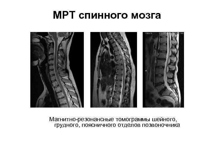 МРТ спинного мозга Магнитно-резонансные томограммы шейного, грудного, поясничного отделов позвоночника 