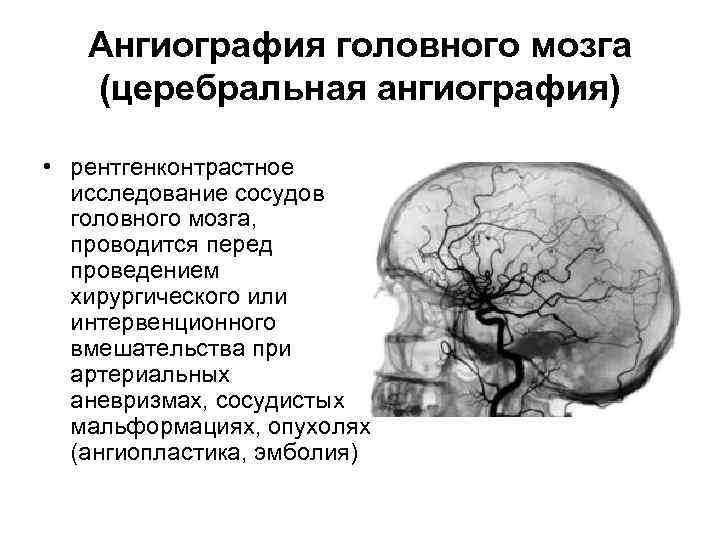 Ангиография головного мозга (церебральная ангиография) • рентгенконтрастное исследование сосудов головного мозга, проводится перед проведением