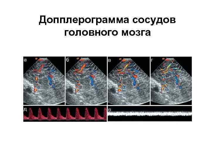 Допплерограмма сосудов головного мозга 