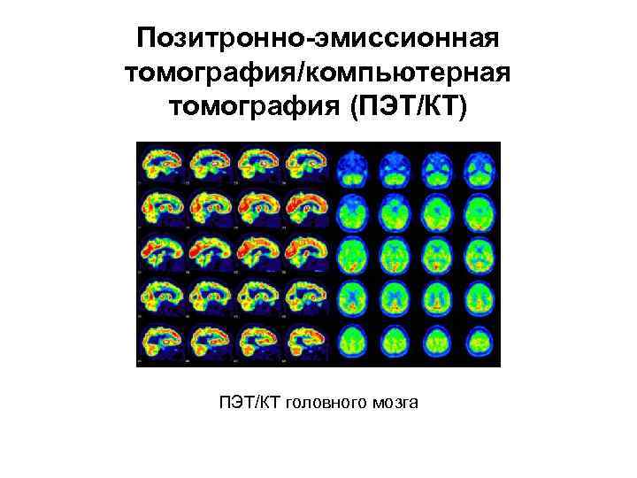 Позитронно-эмиссионная томография/компьютерная томография (ПЭТ/КТ) ПЭТ/КТ головного мозга 