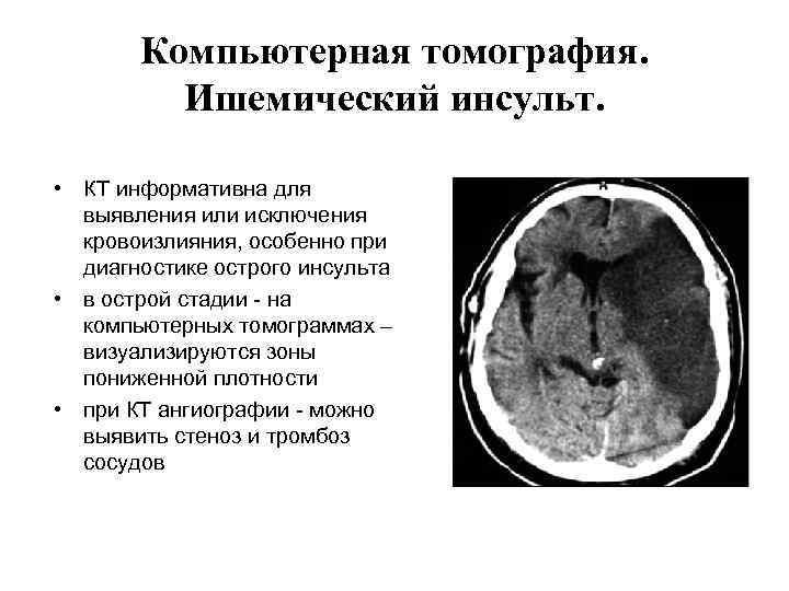 Компьютерная томография. Ишемический инсульт. • КТ информативна для выявления или исключения кровоизлияния, особенно при