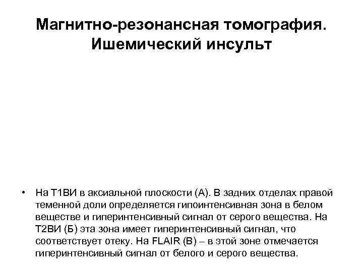 Магнитно-резонансная томография. Ишемический инсульт • На Т 1 ВИ в аксиальной плоскости (А). В