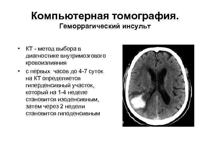 Компьютерная томография. Геморрагический инсульт • КТ - метод выбора в диагностике внутримозгового кровоизлияния •