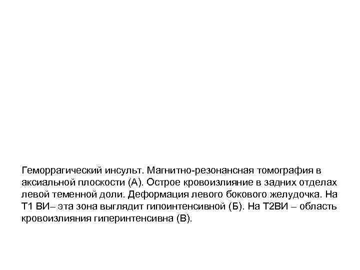 Геморрагический инсульт. Магнитно-резонансная томография в аксиальной плоскости (А). Острое кровоизлияние в задних отделах левой