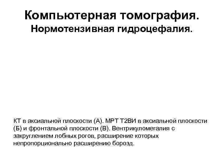 Компьютерная томография. Нормотензивная гидроцефалия. КТ в аксиальной плоскости (А). МРТ Т 2 ВИ в