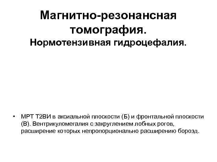 Магнитно-резонансная томография. Нормотензивная гидроцефалия. • МРТ Т 2 ВИ в аксиальной плоскости (Б) и