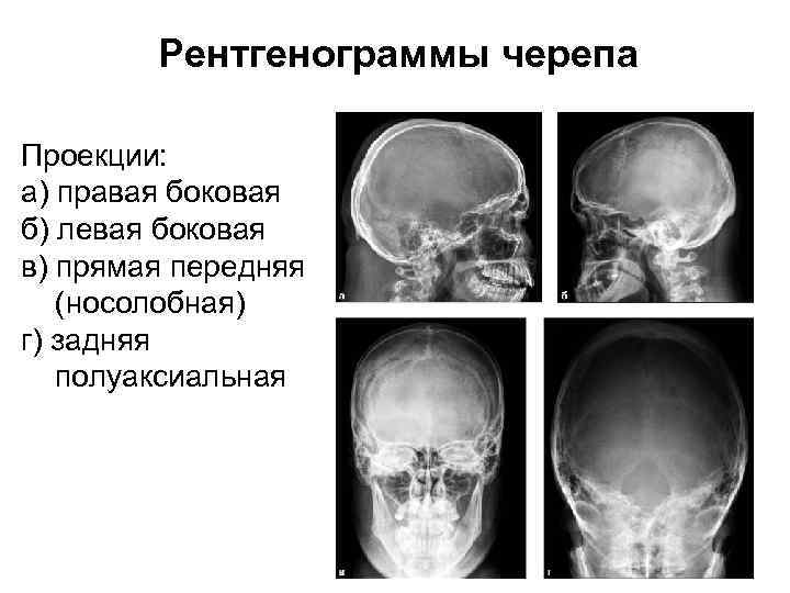 Рентгенограммы черепа Проекции: а) правая боковая б) левая боковая в) прямая передняя (носолобная) г)