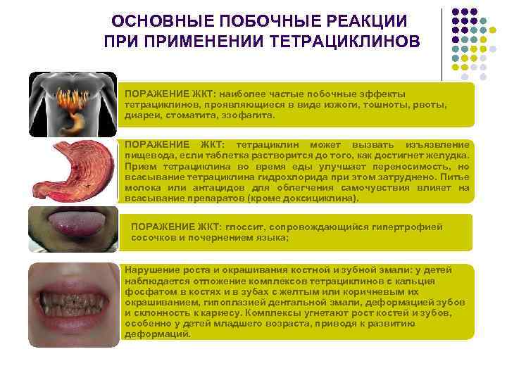 ОСНОВНЫЕ ПОБОЧНЫЕ РЕАКЦИИ ПРИМЕНЕНИИ ТЕТРАЦИКЛИНОВ ПОРАЖЕНИЕ ЖКТ: наиболее частые побочные эффекты тетрациклинов, проявляющиеся в