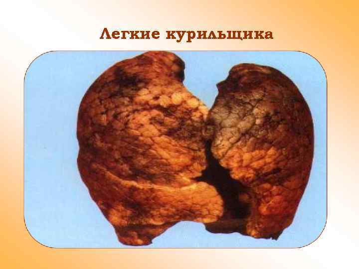 Легкие курильщика 