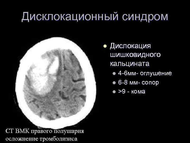 Дисклокационный синдром l Дислокация шишковидного кальцината l l l CT ВМК правого полушария осложнение