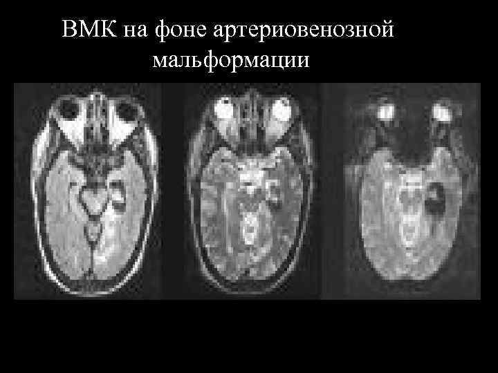 ВМК на фоне артериовенозной мальформации 