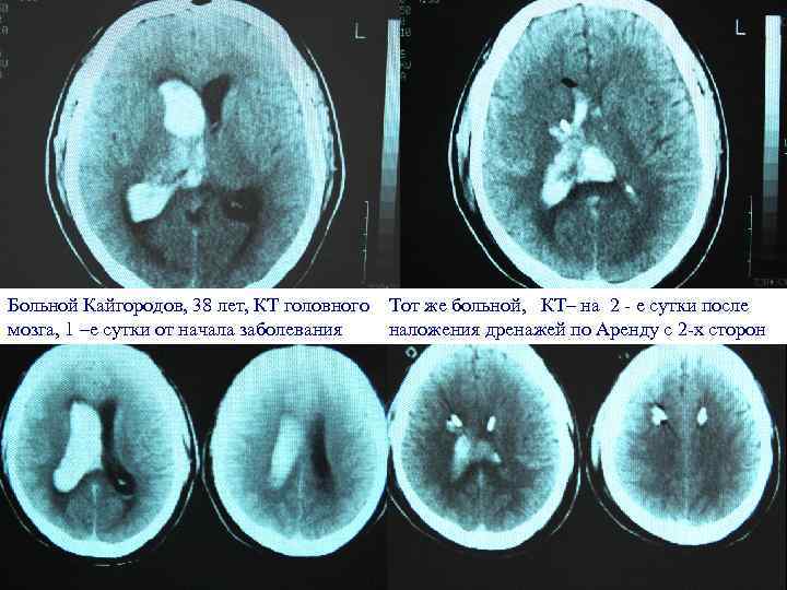 Больной Кайгородов, 38 лет, КТ головного Тот же больной, КТ– на 2 - е