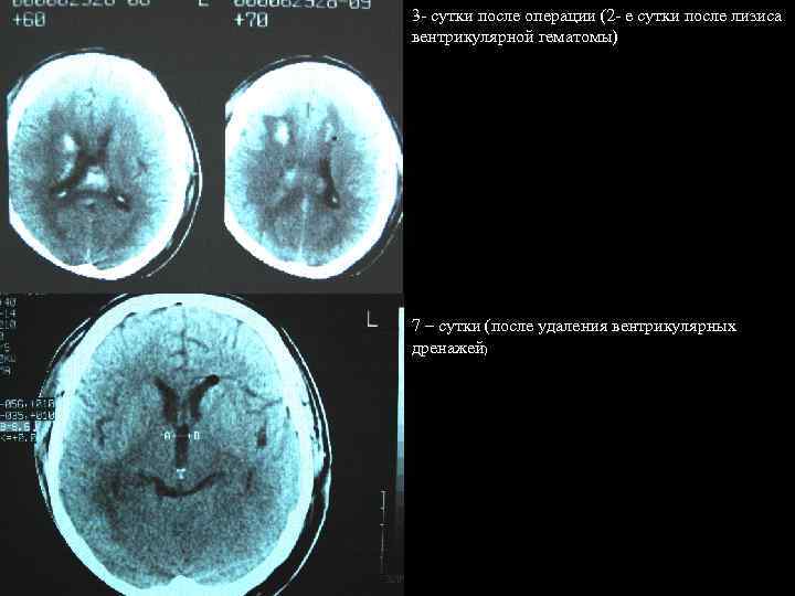 3 - сутки после операции (2 - е сутки после лизиса вентрикулярной гематомы) 7