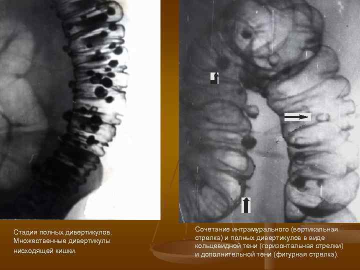 Стадия полных дивертикулов. Множественные дивертикулы нисходящей кишки. Сочетание интрамурального (вертикальная стрелка) и полных дивертикулов