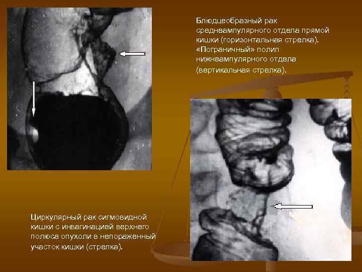 Блюдцеобразный рак среднеампулярного отдела прямой кишки (горизонтальная стрелка). «Пограничный» полип нижнеампулярного отдела (вертикальная стрелка).