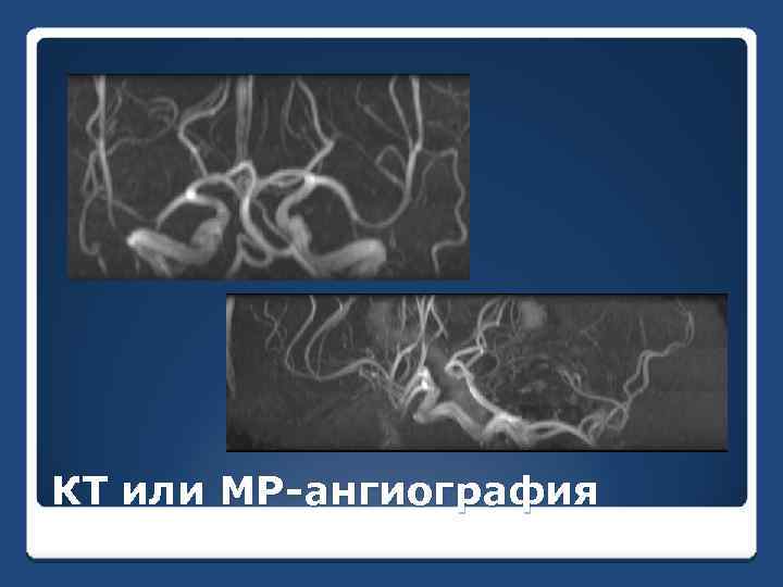 КТ или МР-ангиография 