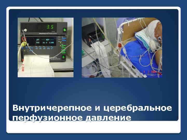 Внутричерепное и церебральное перфузионное давление 