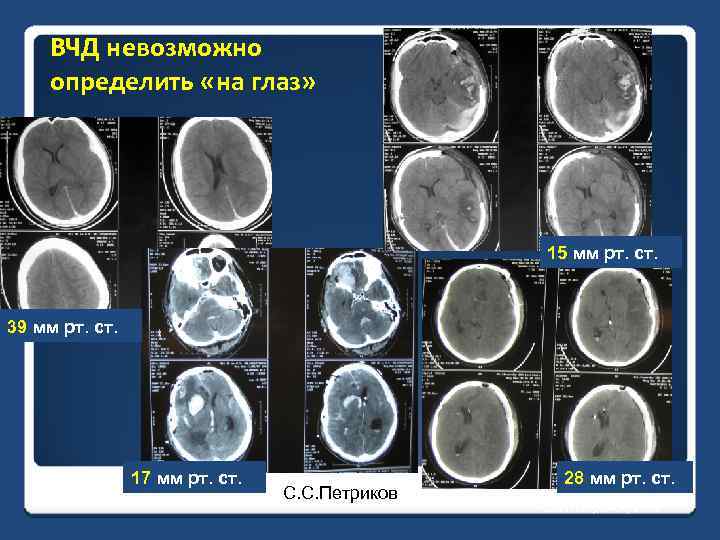 ВЧД невозможно определить «на глаз» 15 мм рт. ст. 39 мм рт. ст. 17